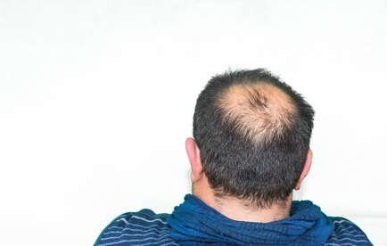 Mann mit Haarausfall